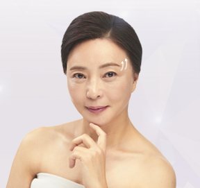 내시경 눈썹거상술 — 눈가에 흰 곡선 표시가 있는 중년 여성 모델