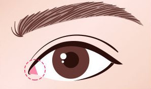 수술방법 01 — 앞트임 외부 흉터 재건(눈 앞머리 분홍 점선 원 표시 눈 그림)