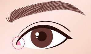 수술방법 02 — 눈 내부 인대와 근조직 재배치로 눈 앞쪽 형태를 바로 잡은 눈 그림